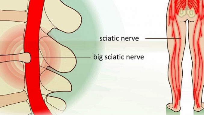 THS_June_12_Thur_12_Sciatica_pain-798x418-678x381